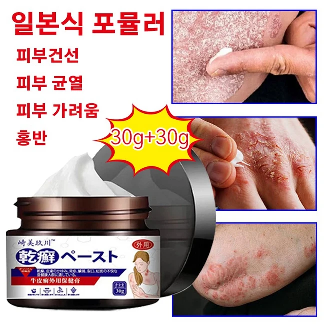 건선 건선 크림 습진 피부 가려움증 홍반 피부 균열 보습 크림, 2개, 30g