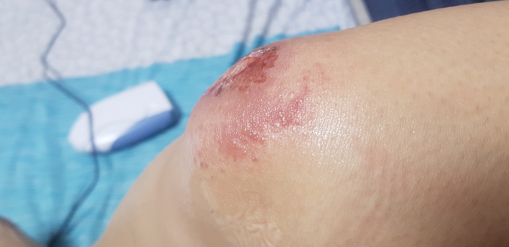 네오메디제약 맘스덤 잘라쓰는 하이드로콜로이드 습윤밴드 대형 1매