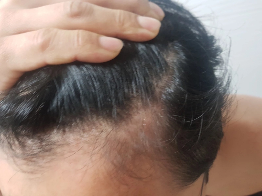 알지쓰리 헤어로스 크리닉 탈모 증상 완화 샴푸