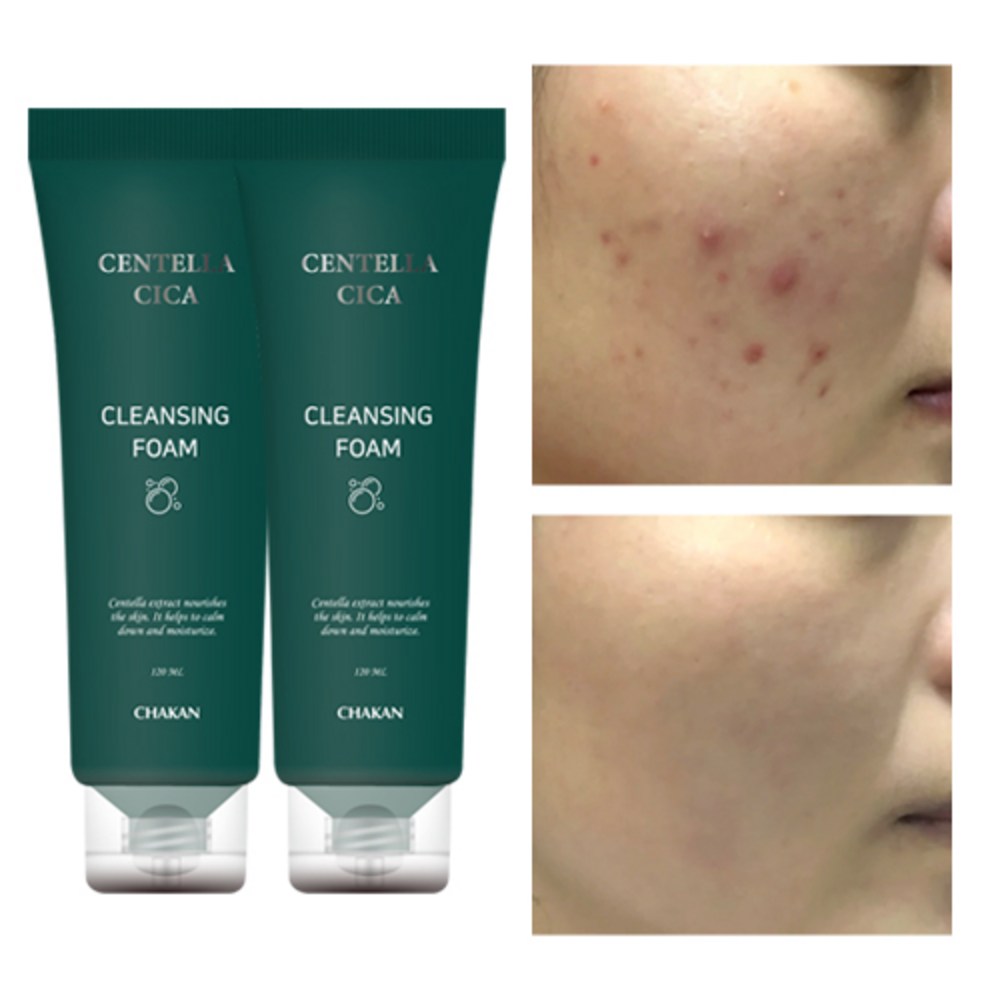 여드름 기능성 클렌징폼: 당신의 피부 고민에 대한 해결책 여드름폼클렌징