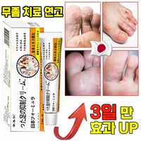 [국내배송] 연고 발 가려움증 완화 연고 발냄새 제거 발각질 문제성발 제거 크림, 2개, 20g