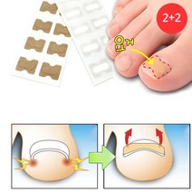 [소공원] 2+2 내성 발톱 교정 보호 테이프 파고드는 내향성 엄지발톱 자가치료, 1개