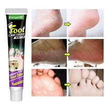 무좀 치료 발가려움 연고 항감염 무좀치료제 풋 케어 연고, 20g, 2개, 1개