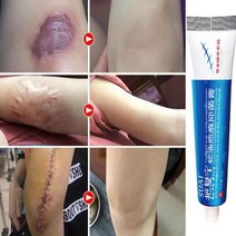 흉터 제거 크림 여드름 흉터 젤 스트레치 마크 바디 올바른 흉터 반점 수리 색소 침착 스무딩 수술용 케어 cree P8a1 20g, 01. A