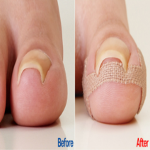 내성발톱테이프 내향성발톱 파고드는 내성 발톱 교정 밴드