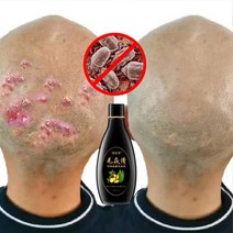 두피 모낭 샴푸 항균 가려움증 진드기 오일 컨트롤 건선 및 클렌징 스킨 케어 제품