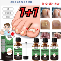1+1 조갑사상균증 치료제 갑구염 복구 30ml 화농성 및 부종/ 폴립 통증/ 조내생, *3+3(30ml/병)