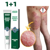 SOUTH MOON 건선 연고 피부건선 모낭염 두드러기 건선 허브 연고, 2개