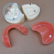 관리 학습 이빨 치위생 스케일링 교구재 비교 구조 잇몸 학원 수업용 임플란트 치아모형, 2개의 부착체 모형