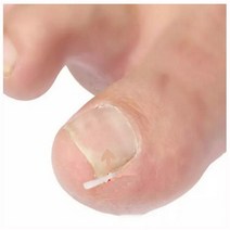 내성발톱 교정 커브스틱 내성발톱테이프 u자형 10p