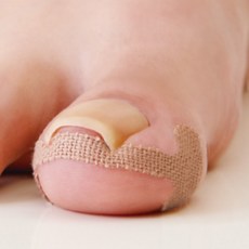 내성발톱교정기 테이프 자가치료, 기본