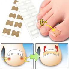 내향성발톱 교정테이프 내성발톱 자가관리 보호 테이프 1장(10P구성), 4장 (40P)