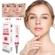 재생크림 여드름리페어연고 색소침착 여드름흉터 수술흉터 피지케어크림, 1개, 30g