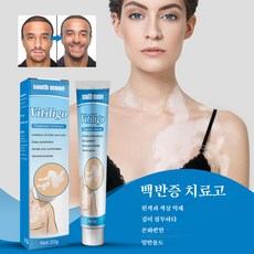 백반증커버