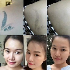 반영구아이라인제거