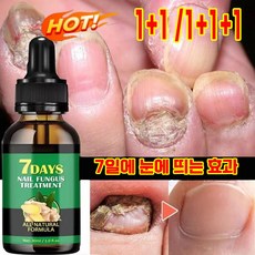 1+1 손 발톱 무좀 영양제 셀라큐어 문제성톱 네일 솔루션 리페어 앰플 에센스 톱강화, 1(1+1아님), 2개 - 레오클린