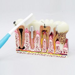 MY005 치과치료모형 충치 및 신경치료 설명 치아모형 환자설명용 치료과정설명
