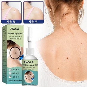 AKOLA [국내배송] 피부 액상 사마귀 치료제 피부 염증 완화 크림, 1개, 20ml