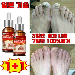 일본 1+1/2+2 손톱 발톱 무좀 영양제 앰플 발톱 관리 케어 손톱발톱 강화제 네일 강화 선물 랜덤 증정, 2개, 30ml