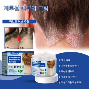 지루성 두피염에 대하여 두피상태 개선/두피가려움 /두피여드름 / 비듬, 1개, 50ml