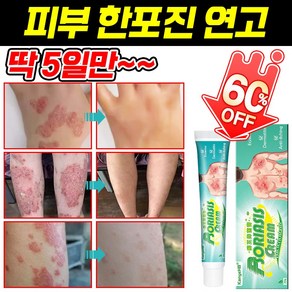 [빠른 배송] 피부 한포진 연고 습진 알레르기 제거 피부 사타구니 가려움증 건조 연고 발포 피부염 제거, 20ml, 2개