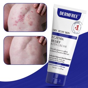 DERMFREE 건선 연고 두드러기 피부 가려움 크림, 3개, 100ml