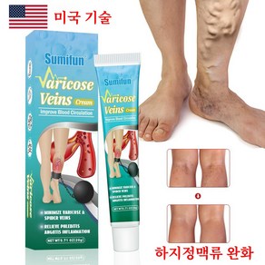 하지정맥크림 붓기크림 정맥류 연고 다리 거미 제거 치료 통증 완화 크림 혈관염 수리 정맥염 드레싱, 2개