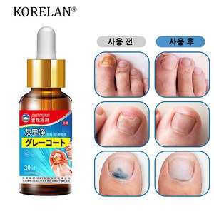 발톱무좀 케어 살균 빠진다 변색 발톱 두꺼워짐 갈라짐, 1개, 30ml