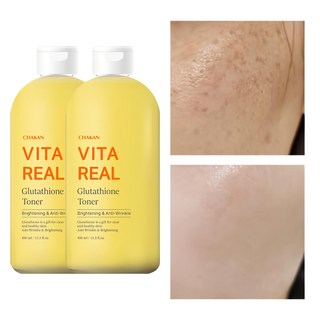 3. 기미 잡티 주근..