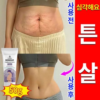 튼살 크림 바디케어 비만주름, 3개, 50g