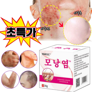 [국내배송] 피부 가려움 두피 케어 크림 여드름 스팟크림, 2개, 30g