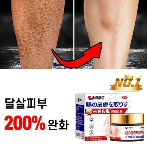 호주수도크림 - [200%완화] 일본 모공 각화증 바디로션 닭살 피부 제거 크림 뱀살 연화 보습제, 50g, 1개, 50g