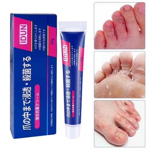 찝찝함은 가라! 상쾌한 발걸음을 위한 혁신적인 솔루션 무좀약