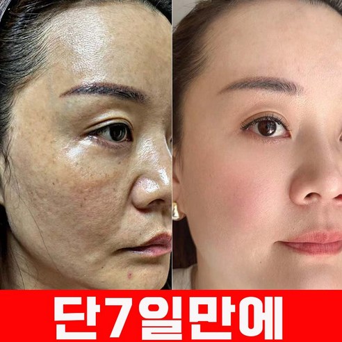 멜라케어 마스크팩으로 되찾는 빛나는 피부 자신감