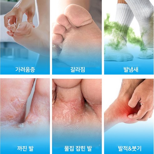 3일 만에 무좀 고민 끝! FDA 승인 무좀약으로 깨끗한 발을 되찾으세요.