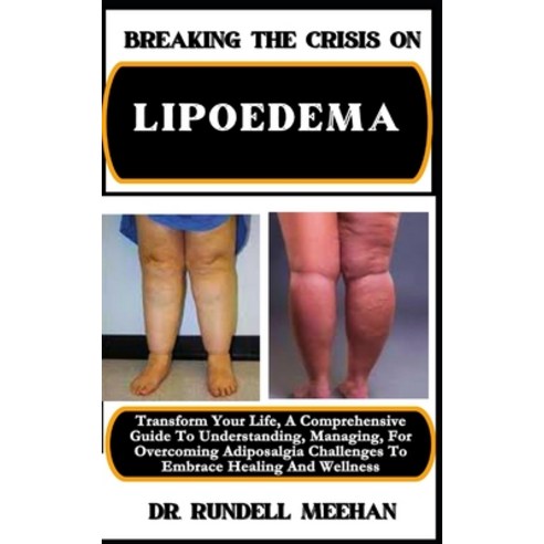 (영문도서) Breaking the Crisis on Lipoedema: Transform Your Life A Comprehensive Guide To Understanding... Paperback, Independently Published, English, 9798883348579