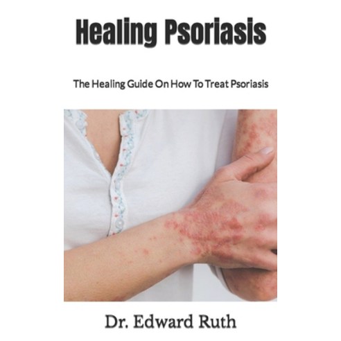 (영문도서) Healing Psoriasis: The Healing Guide On How To Treat Psoriasis Paperback, Independently Published, English, 9798498224855