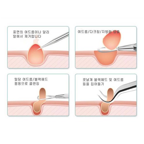 [독일기술] 코 피지 제거기 여드름 압출기 피지 핀셋 바늘 블랙헤드 뾰루지 비립종 독일 피부과 전용 공구 8종 세트, 1개