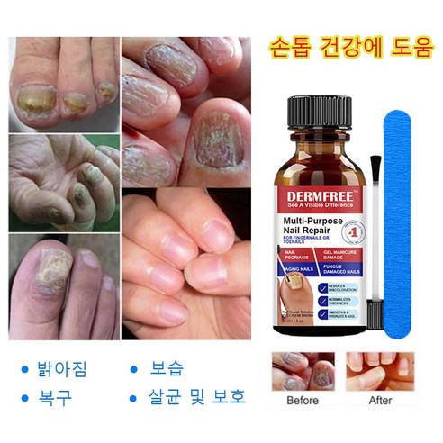 손톱무좀 복구 에센스 손발톱사상균증 전용입니다 NailFungus 발톱무좀약 큐티클 셀라큐어문제성발톱셀라솔루션 손톱물어뜯기방지 30ml 손톱네일 손톱영양제, 1개