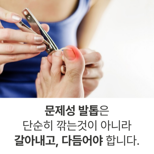 더 이상 숨기지 마세요! 파고드는 발톱, 집에서 쉽고 깔끔하게 관리하세요.