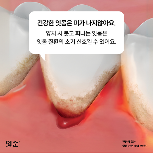 잇순플러스 분말형으로 잇몸 고민 끝내고 상쾌한 미소를 되찾으세요.