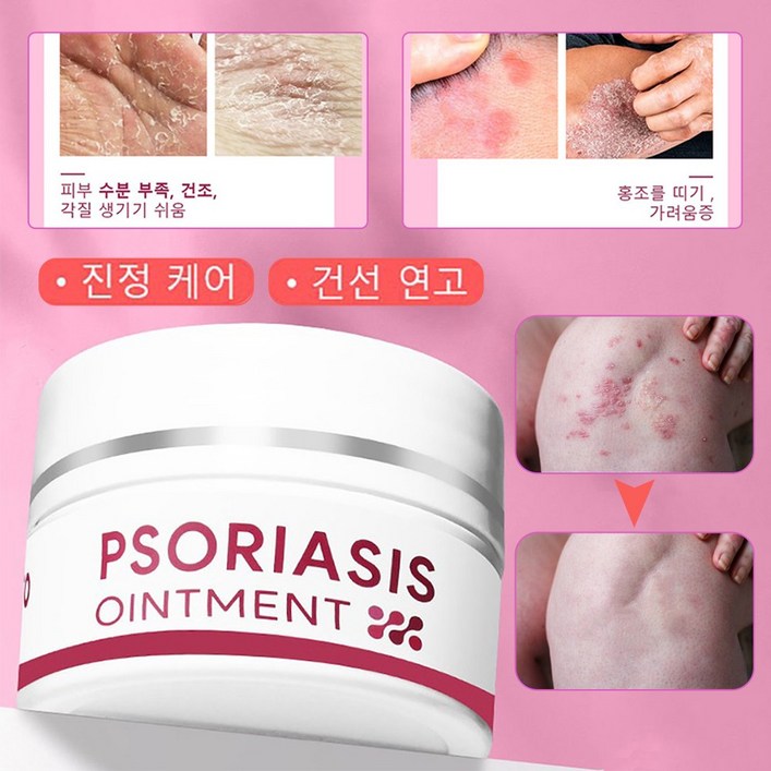 피부가려움증 건선연고 보습크림, 25g, 2개