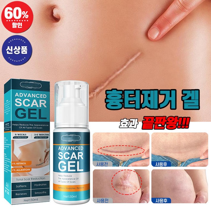국내배송 흉터제거 연고 제왕절개 화상 수술 상처 피부흉터 제거겔 켈로이드 치료 리페어 크림 국내배송 흉터제거 연고 제왕절개 화상 수술 상처 피부흉터 제거겔 켈로이드 치료 리페어 크림